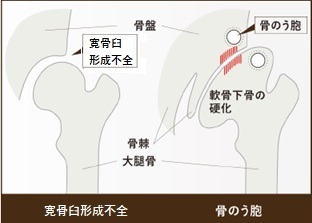 画像：寛骨臼形成不全