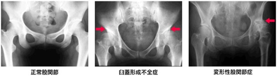 画像：変形性股関節症