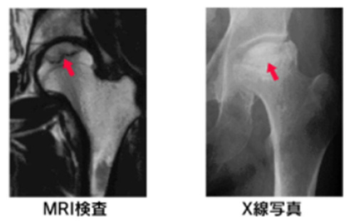 画像：特発性大腿骨壊死症
