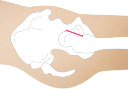 画像：前方侵入法