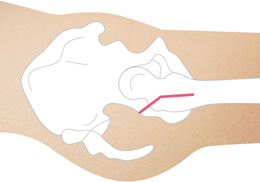 画像：外側侵入法