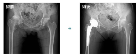 画像：大腿骨壊死症