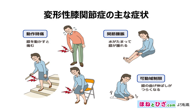 画像：変形性膝関節症の主な症状