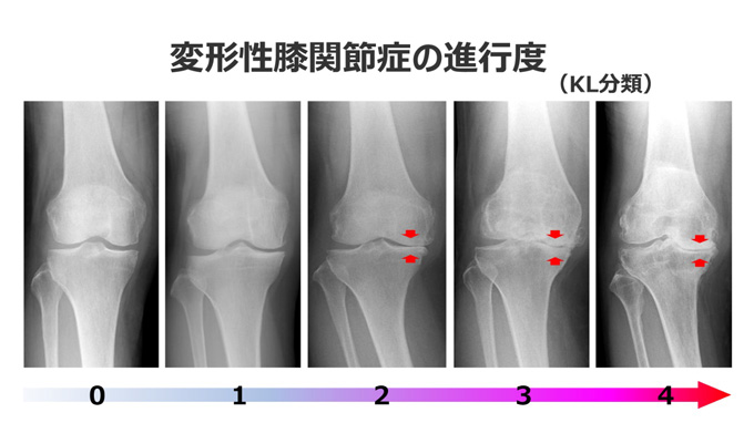 画像：変形性膝関節症の進行度