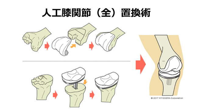 画像：人工膝関節置換術