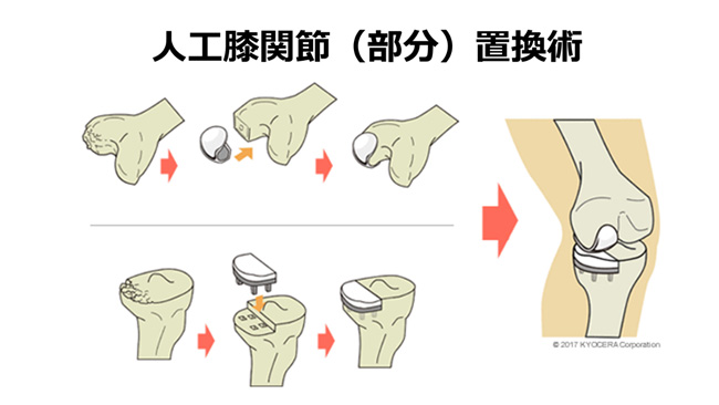 画像：人工膝関節置換術