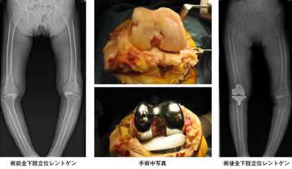 画像：人工膝関節置換術