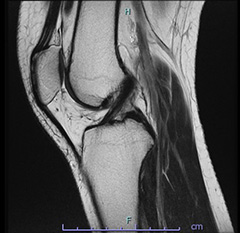 画像：正常な十字靱帯
