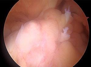 画像：断裂した十字靱帯（関節鏡）