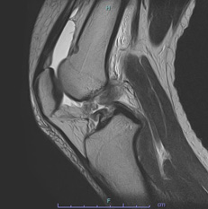 画像：断裂した十字靱帯（MRI）