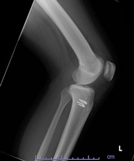 画像：術後レントゲン（側面）