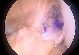 画像：再建した前十字靱帯（関節鏡）