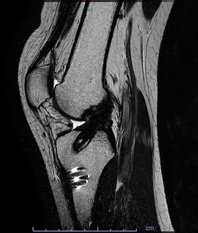 画像：再建した前十字靱帯（MRI）