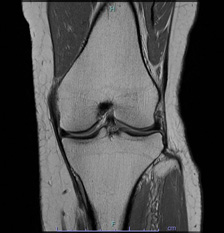 画像：正常な半月板MRI画像（右膝）