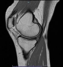 画像：正常な半月板MRI画像（内側）