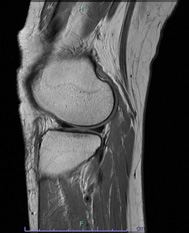 画像：正常な半月板MRI画像（外側）