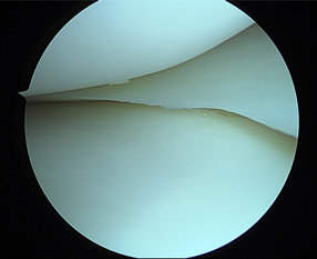 画像：正常な半月板関節鏡画像（内側）