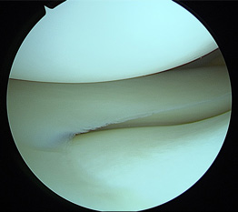 画像：正常な半月板関節鏡画像（外側）