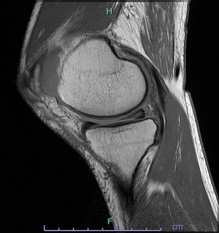 画像：損傷後内側半月板MRI画像（側面）