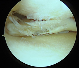 画像：損傷後内側半月板関節鏡画像