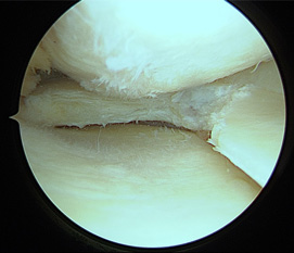 画像：部分切除後内側半月板関節鏡画像