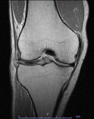 画像：損傷後外側半月板MRI画像（正面）