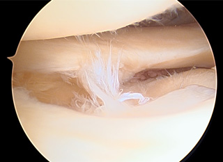 画像：損傷後外側半月板関節鏡画像