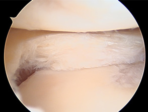 画像：部分切除後外側半月板関節鏡画像