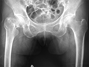 画像：大腿骨近位部骨折