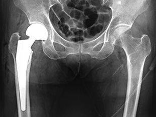 画像：大腿骨近位部骨折