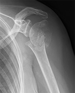 画像：上腕骨近位部骨折