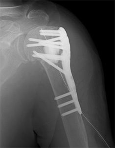 画像：上腕骨近位部骨折