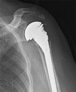 画像：上腕骨近位部骨折