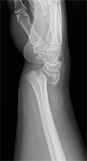 画像：橈骨遠位端骨折