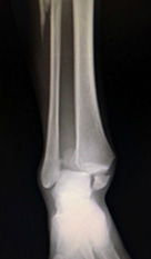 画像：足関節骨折