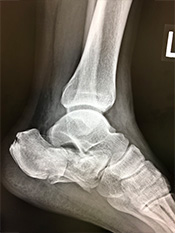 画像：踵骨骨折（かかと骨折）