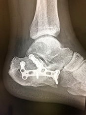 画像：踵骨骨折（かかと骨折）