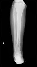 画像：下腿骨折