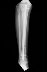 画像：下腿骨折