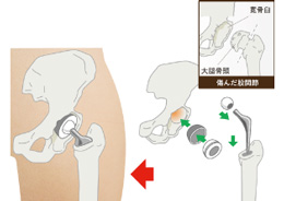 画像：人工股関節置換術
