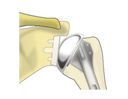 画像：変形性膝関節症の進行度