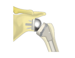 画像：変形性膝関節症の進行度